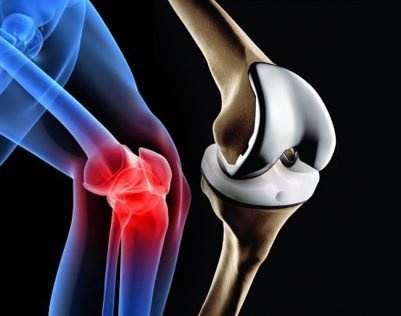 Joint replacement surgery in India