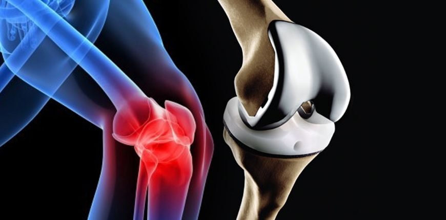Joint replacement surgery in India