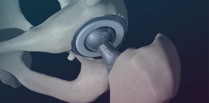 hip replacement surgery in india procedure