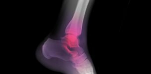 ankle arthroscopy surgery treatment in India