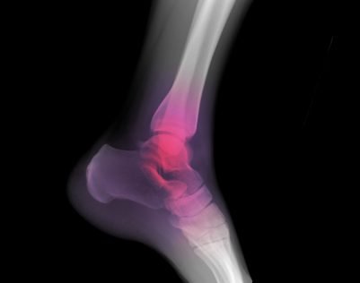 ankle arthroscopy surgery treatment in India