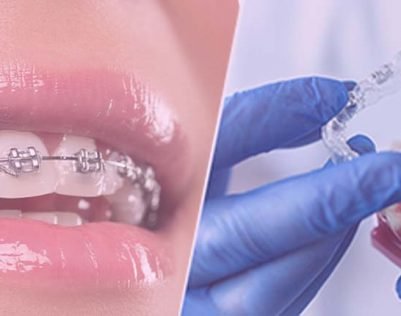 dental-braces-treatment