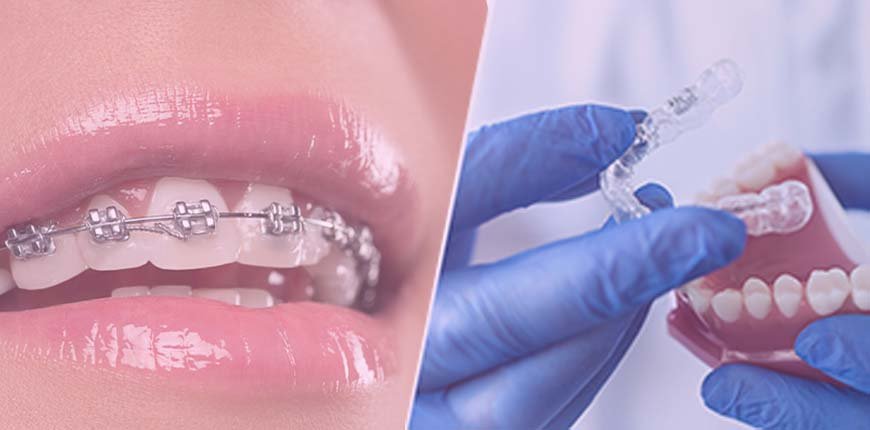 Dental Braces Treatment in India, Cost and More