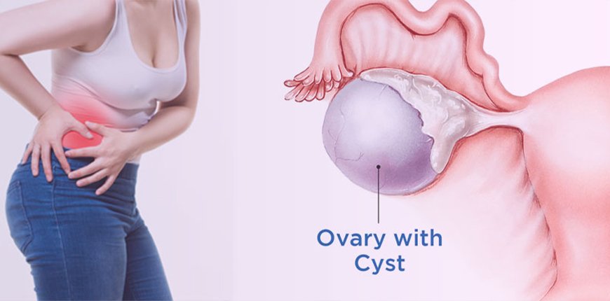 Ovarian Cyst Removal