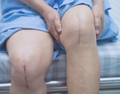 knee-replacement-surgery-india