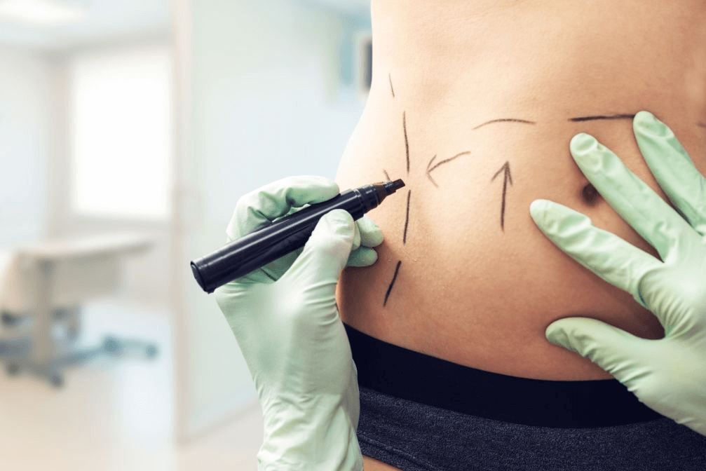 best Liposuction in india