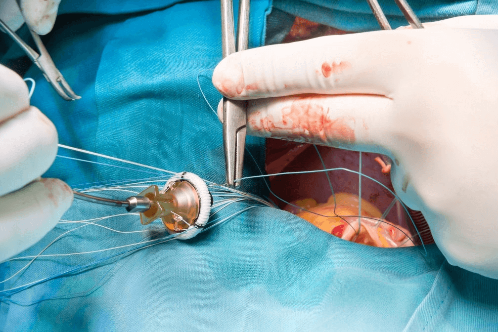 best Heart Valve Replacement Surgery in india