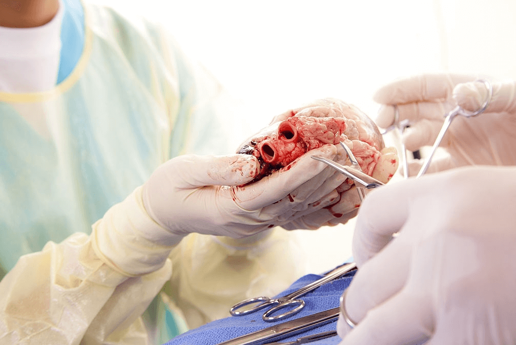 best Heart Transplant in india